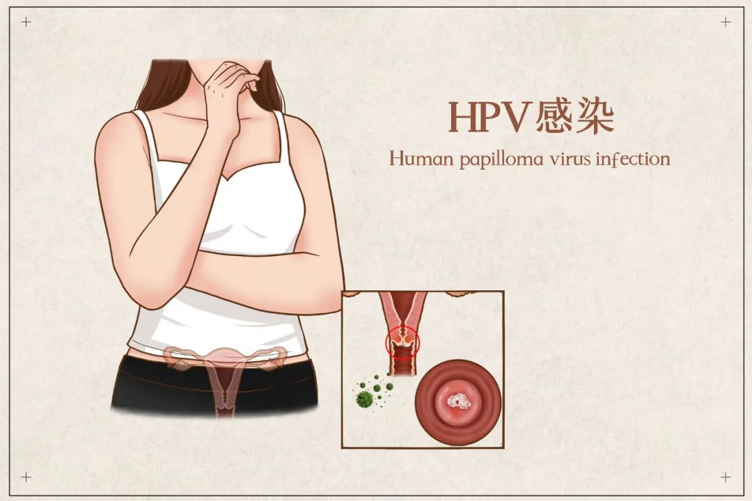 hpv感染