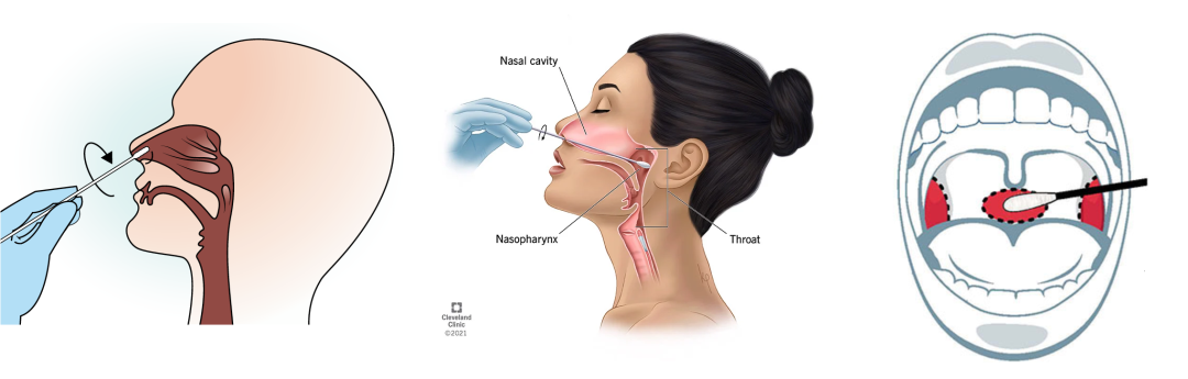 流感咽拭子采样示意图